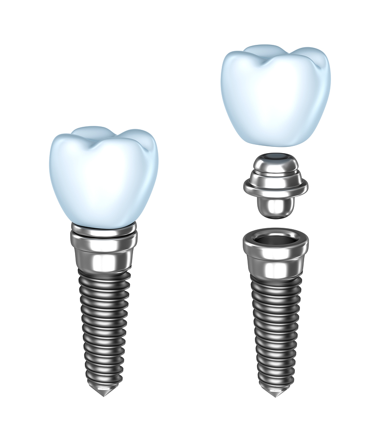 Dental Implants Reston and Vienna VA | Dentist